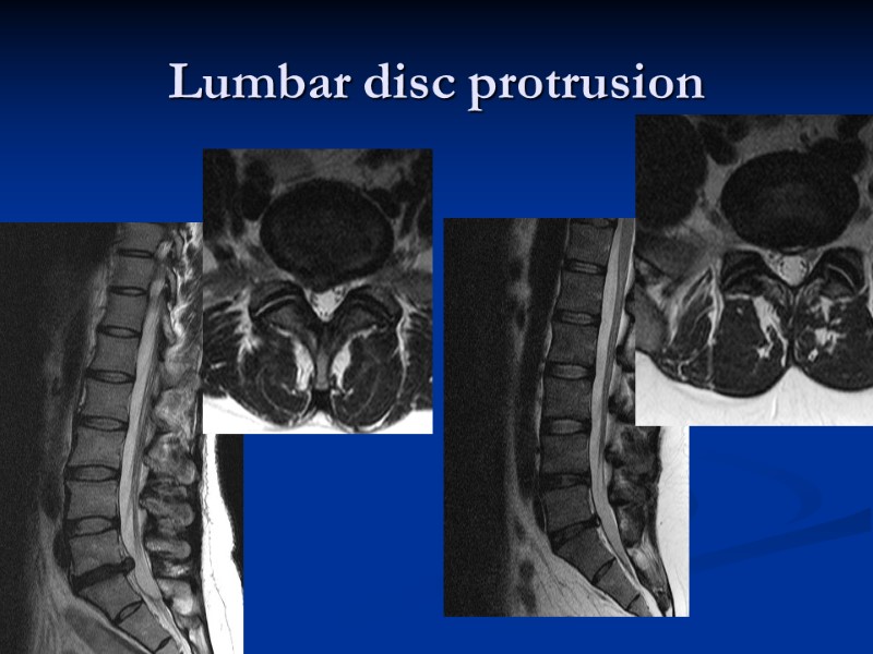 Lumbar disc protrusion